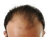 Specific Baldness Pattern Associated with Increased Prostate Cancer Risk