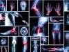 Immune System Regulation May Help Control Rheumatoid Arthritis, Diabetes