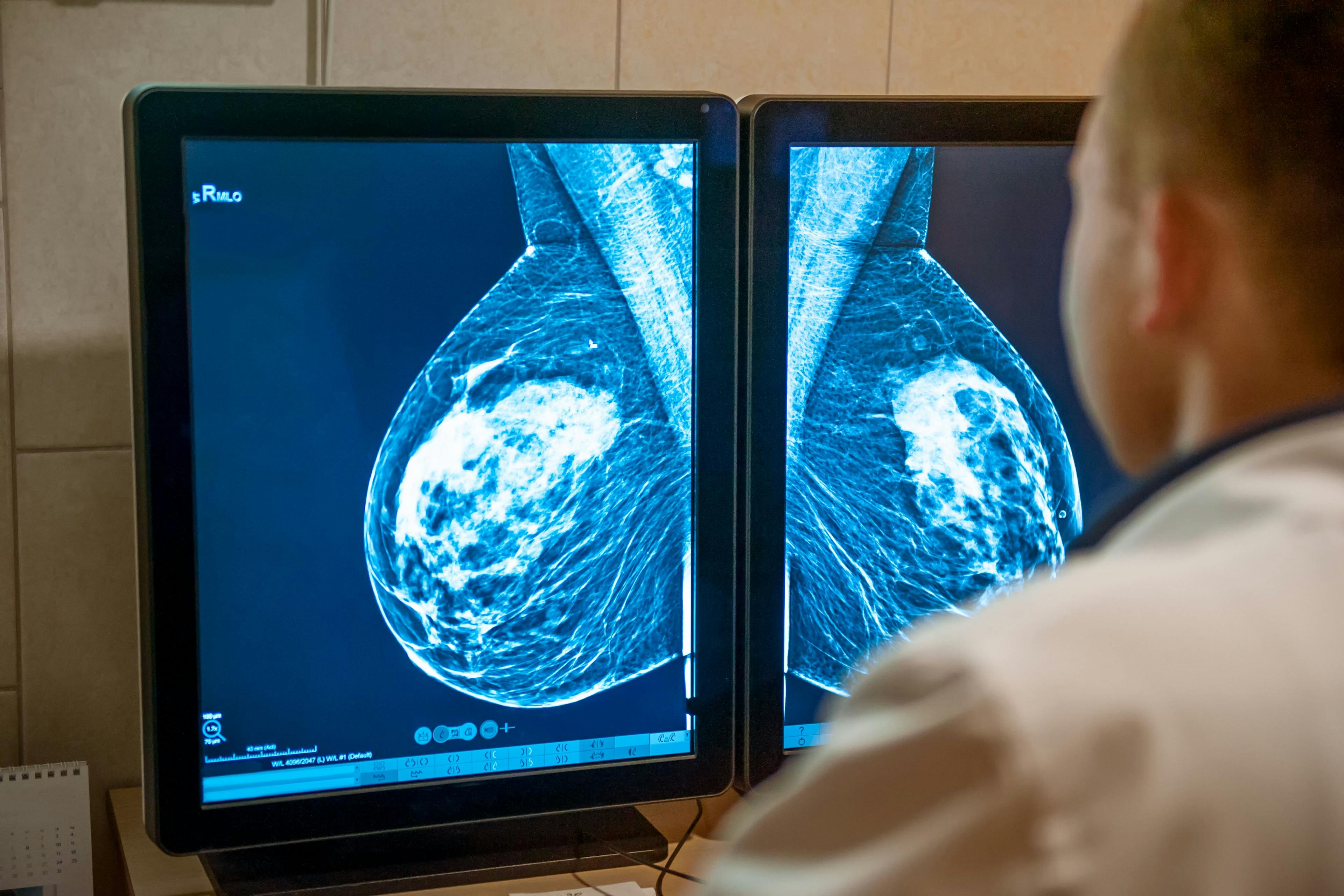 Doctor examines mammogram snapshot of breast of female patient on the monitors. Selective focus Image credit: Okrasiuk | stock.adobe.com