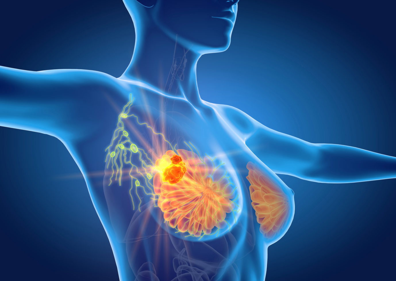Olaparib Found to Significantly Improve Survival in High-Risk Early Breast Cancer 