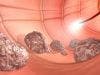 Blood Test May Improve Treatment in Stage 2 Colon Cancer Patients