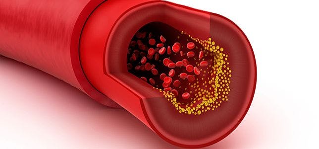 Study Shows Consistent Efficacy, Safety of Inclisiran in Lowering Low-Density Lipoprotein Cholesterol