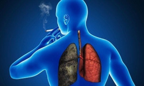 Treatment Decisions for Lung Cancer During COVID-19 Require Balancing Exposure Risk, Effective Care