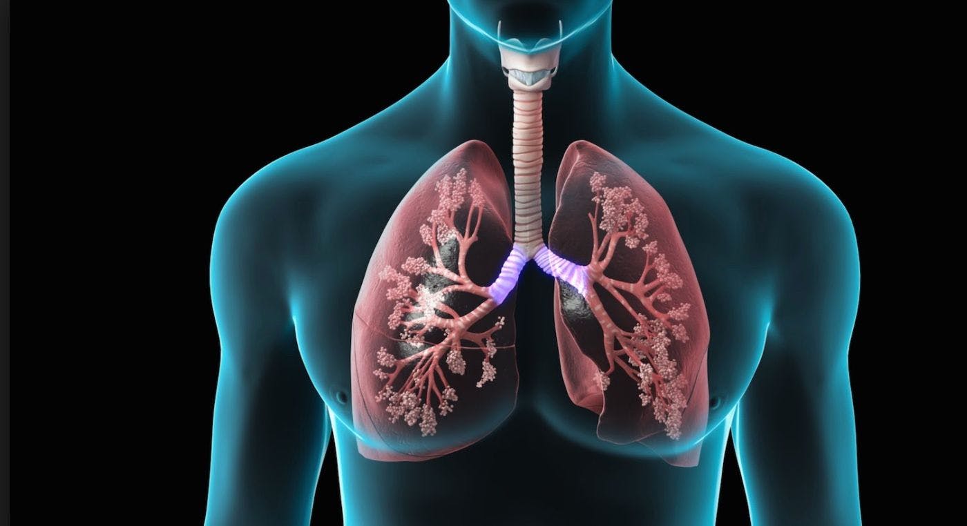 Pembrolizumab Combinations Found Safe, Effective in Non-Small Call Lung Cancer