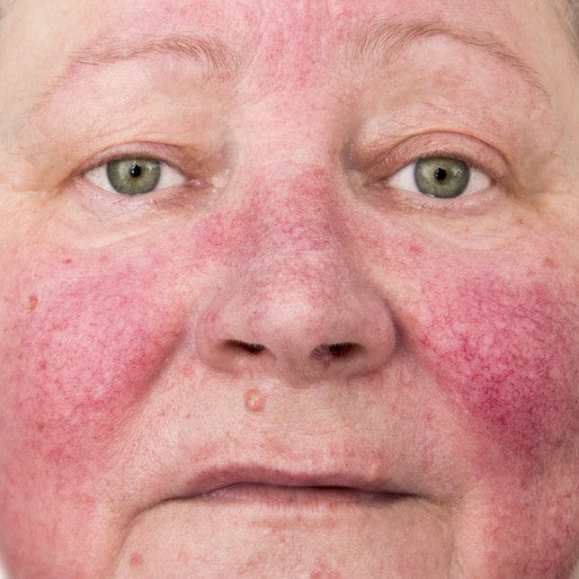 Rosacea Awareness Month Focuses on Management Options