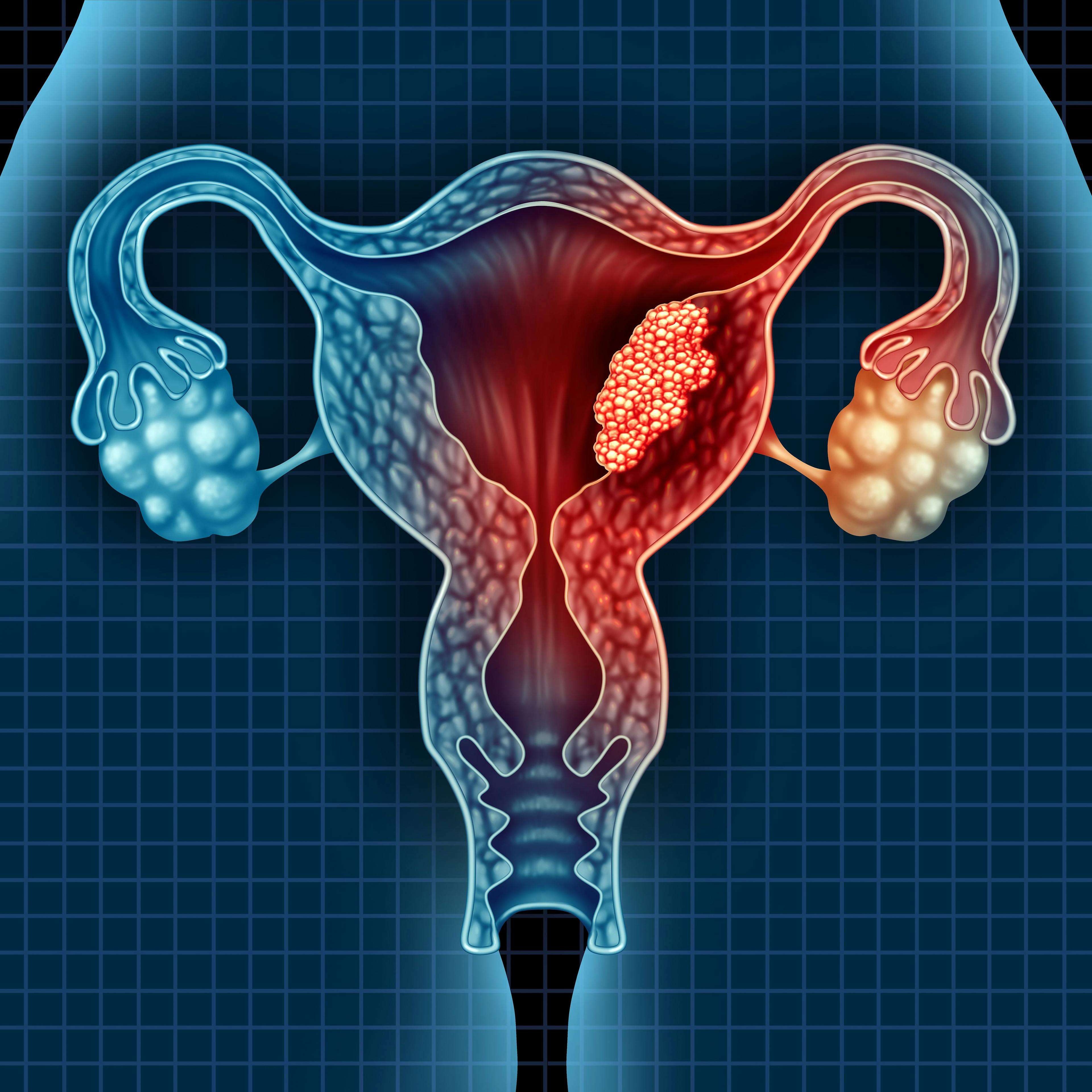 Study: Keytruda Effectively Treats Aggressive Forms of Endometrial Cancer