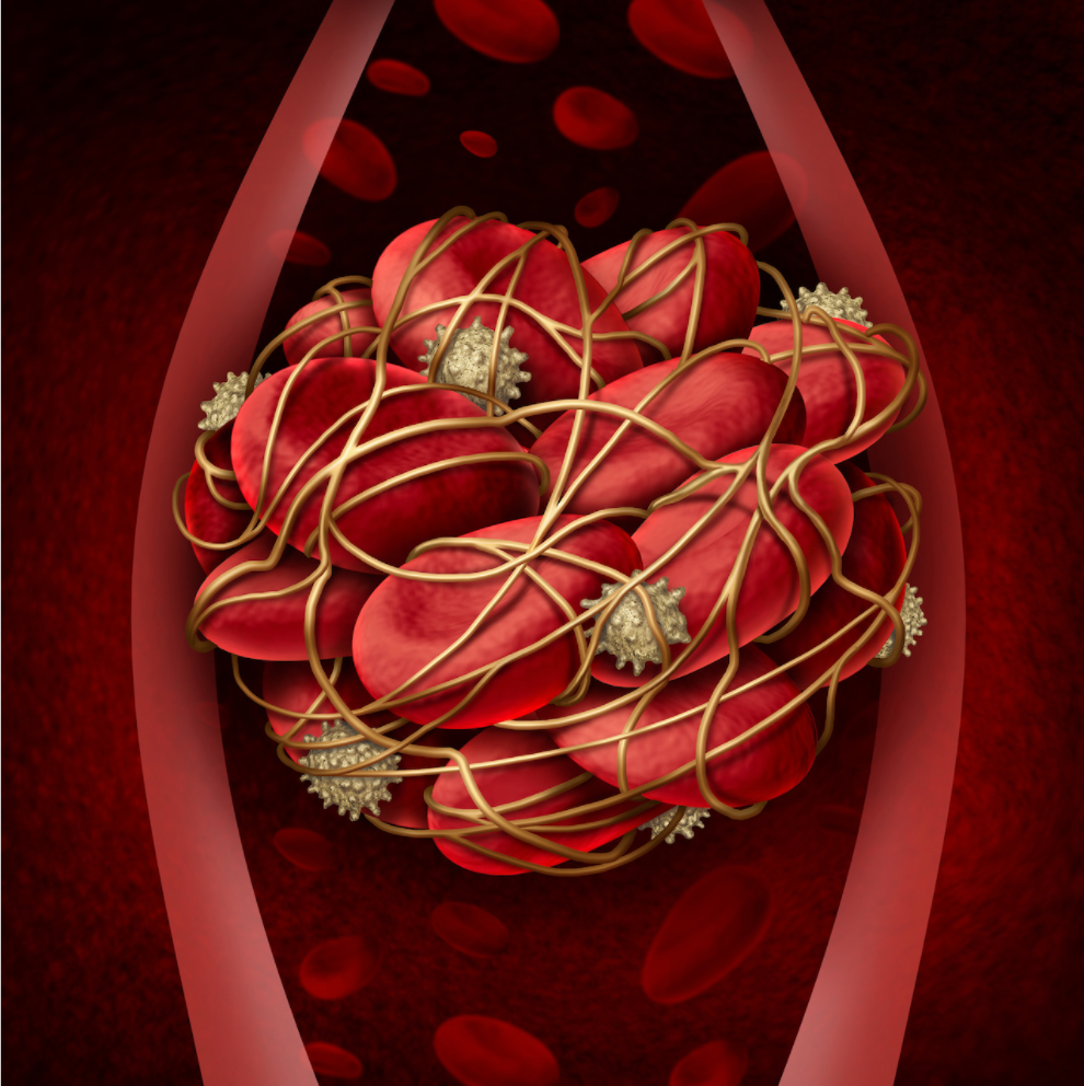 Pharmacy Clinical Pearl of the Day: Deep Vein Thrombosis 
