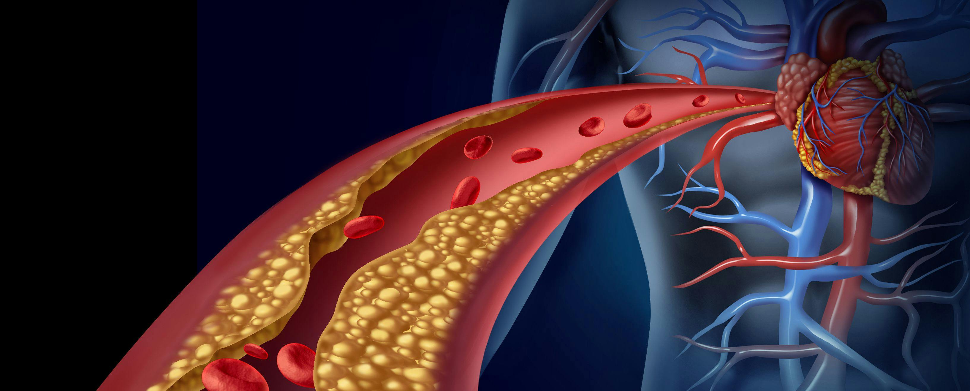 Hypercholesterolemia Treatment Granted FDA Priority Review