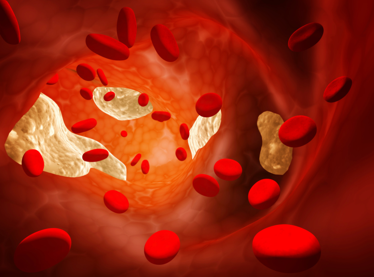 Pharmacist Medication Insights: Evinacumab-dgnb for High Cholesterol