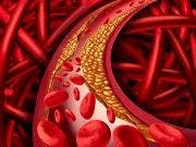 How Many Americans with High Cholesterol Could be Eligible for PCSK9 Inhibitors?