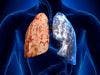 Melanoma Drug Benefits Some Lung Cancer Patients