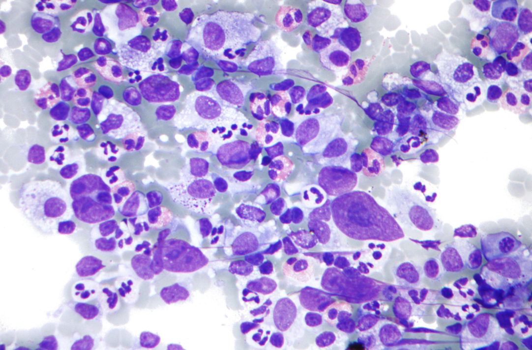 Pharmacy Clinical Pearl of the Day: Hodgkin Lymphoma