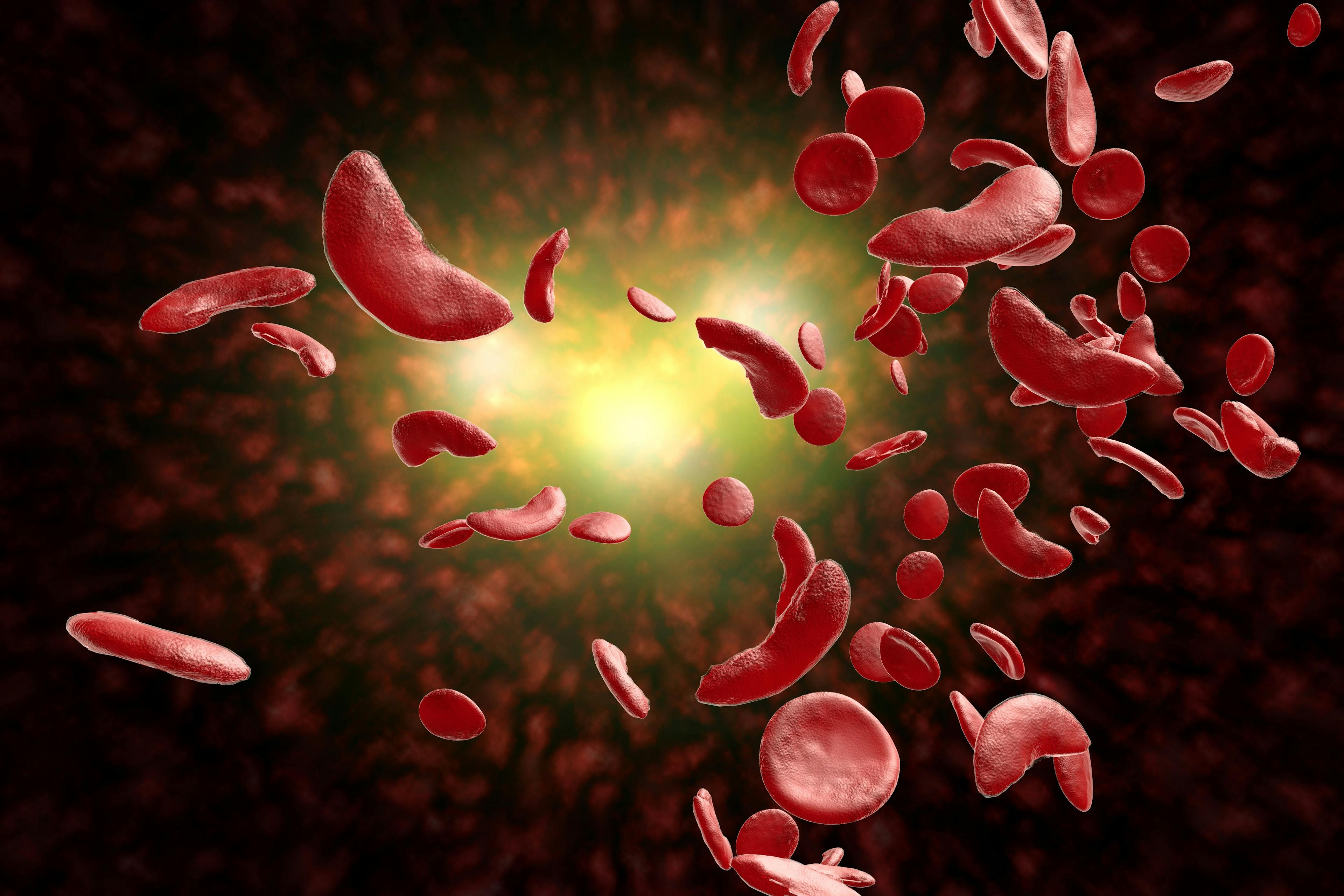 Sickle cell disease red blood cells -- Image credit: Ezume Images | stock.adobe.com