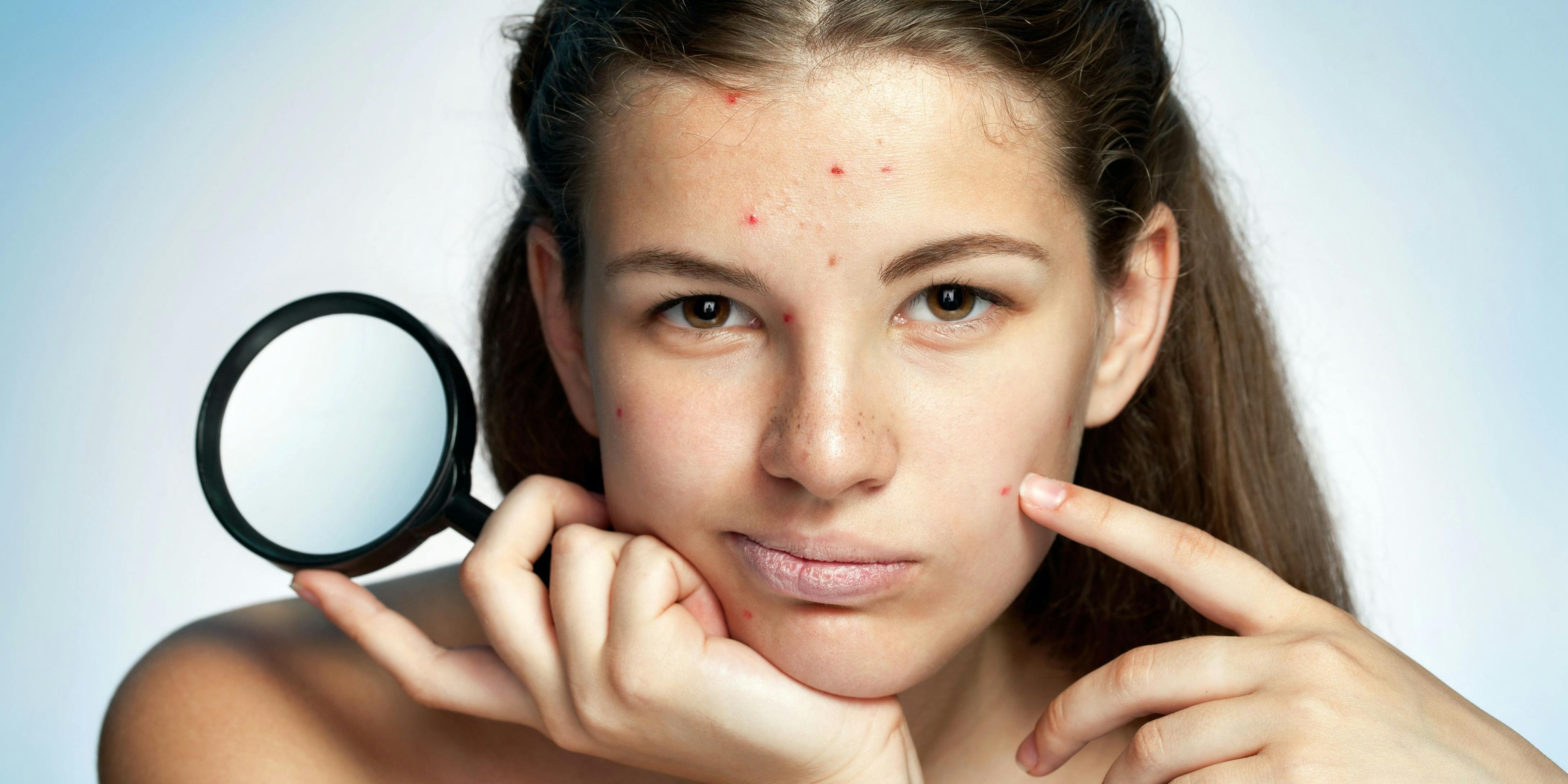FDA Approves New Acne Scar Treatment