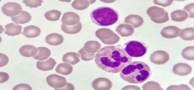 Venetoclax, Azacitidine Combination Improves Overall Survival in Acute Myeloid Leukemia