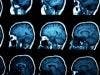 MRI Scans Can Identify HIV in the Brain