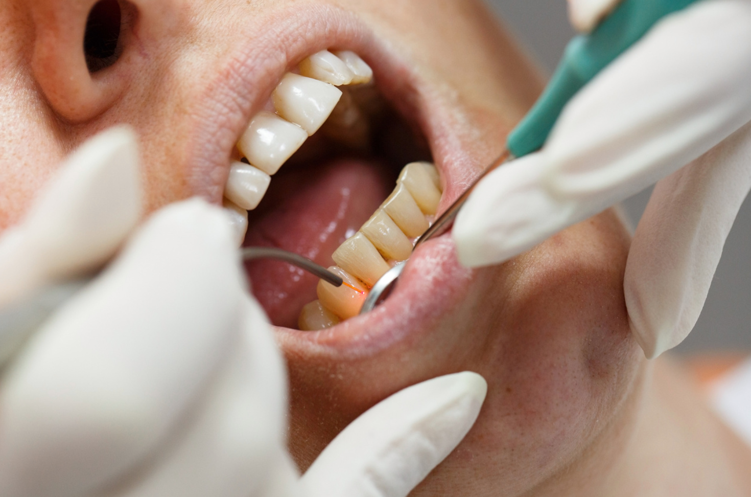 The Link Between Oral Health, General Health in Patients with Diabetes