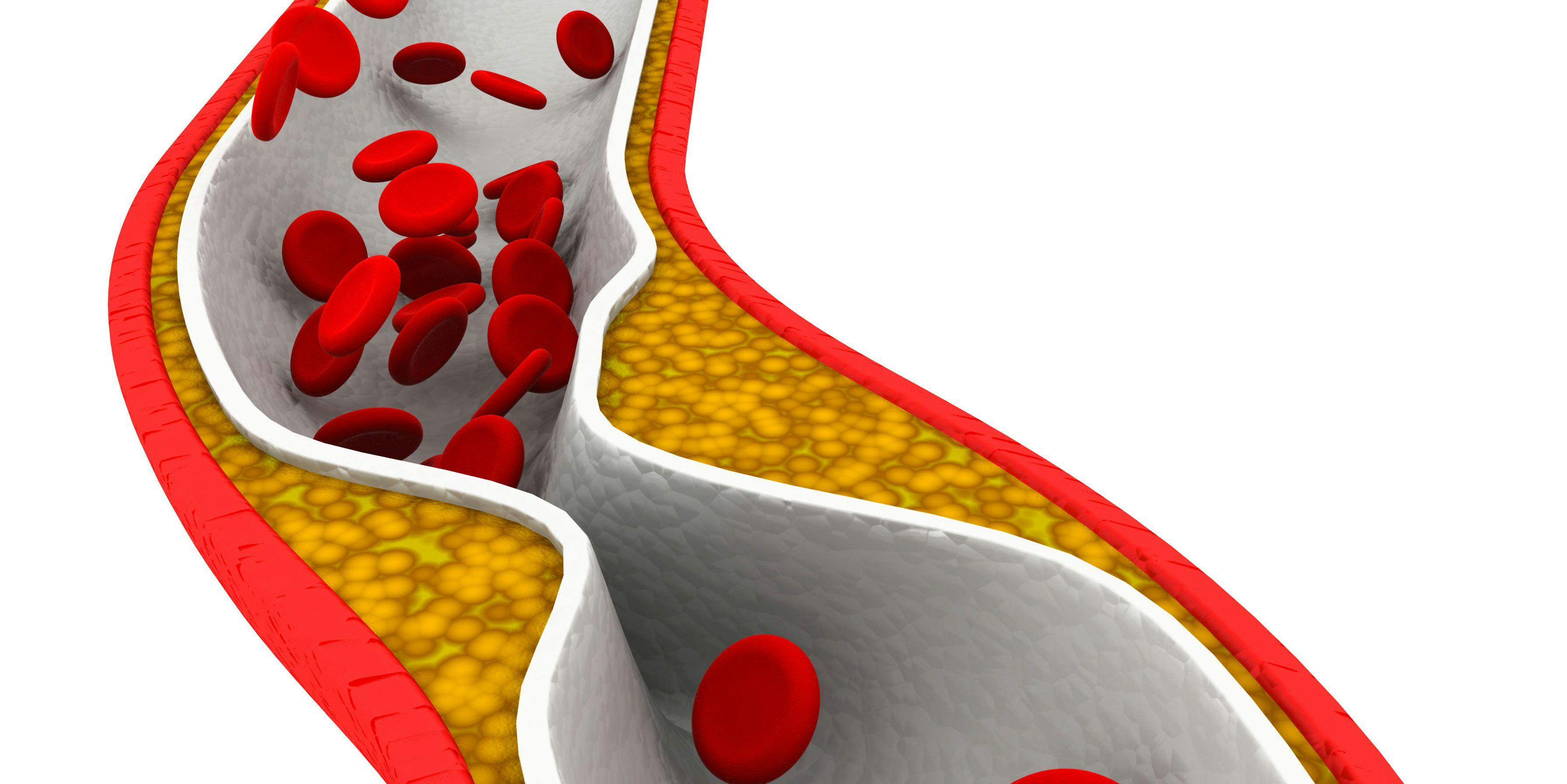 Investigational Drug Shows Promise in Hypercholesterolemia