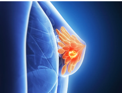 Clinical Trials Update Showcase Regimen That Increased Survival in Patients with High-Risk Types of Early-Stage Breast Cancer