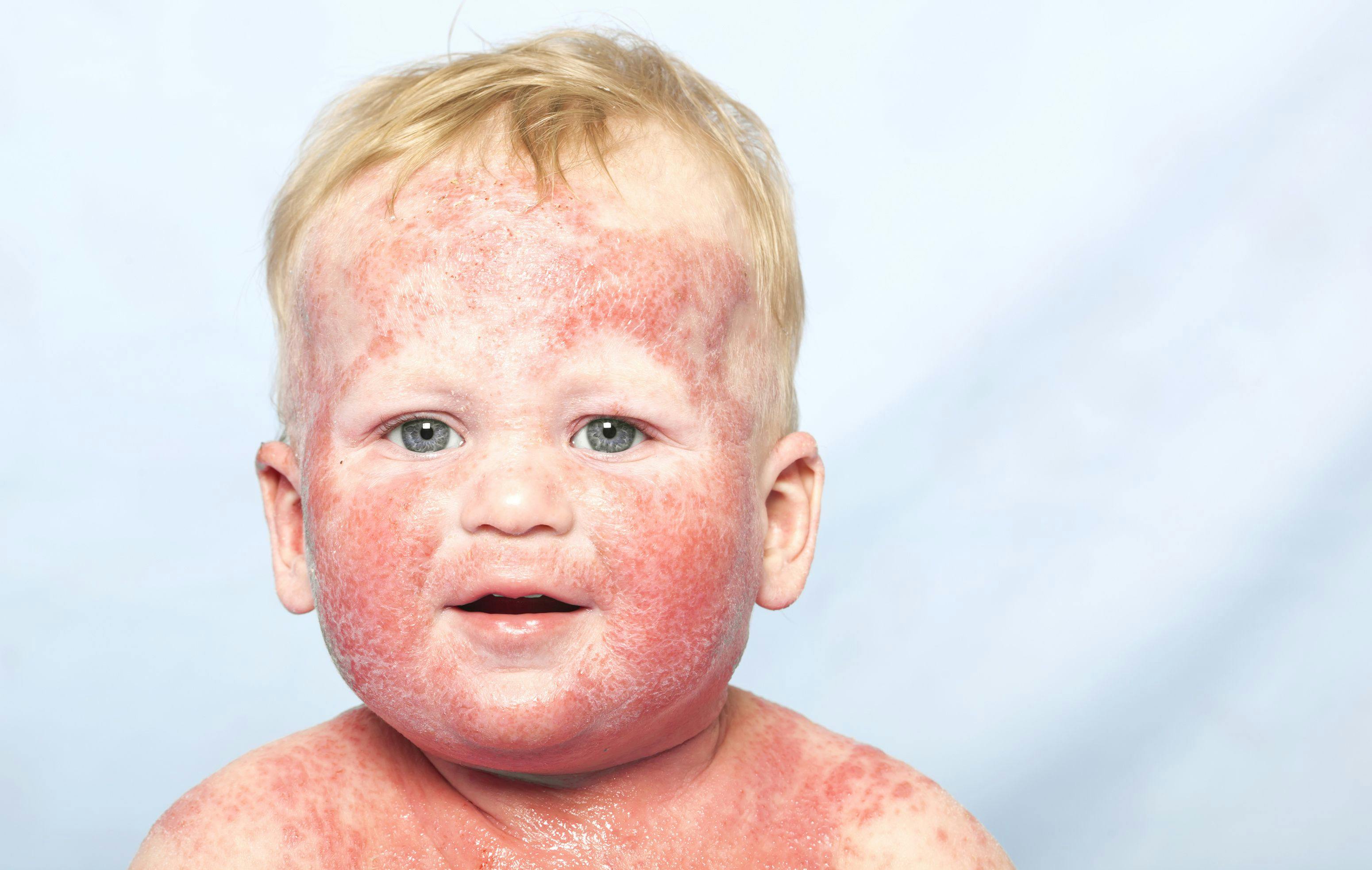 Dupilumab Significantly Reduces Signs, Symptoms of Moderate-to-Severe Atopic Dermatitis in Children 6 Months and Older
