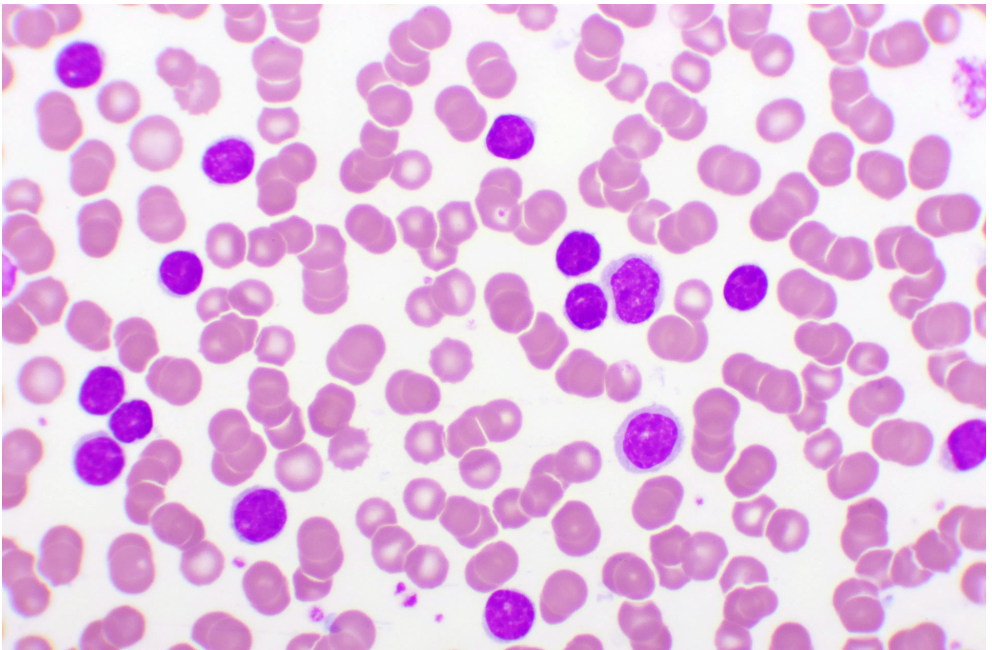 Pharmacy Involvement Can Improve Patient Outcomes When Treating Leukemia