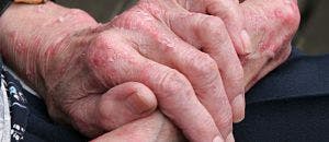 Rheumatoid Arthritis Drug Awarded Breakthrough Status for Systemic Sclerosis