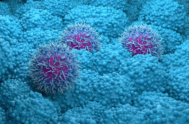 Pancreatic cancer cells closeup 3d render illustration | Image Credit: LASZLO - stock.adobe.com
