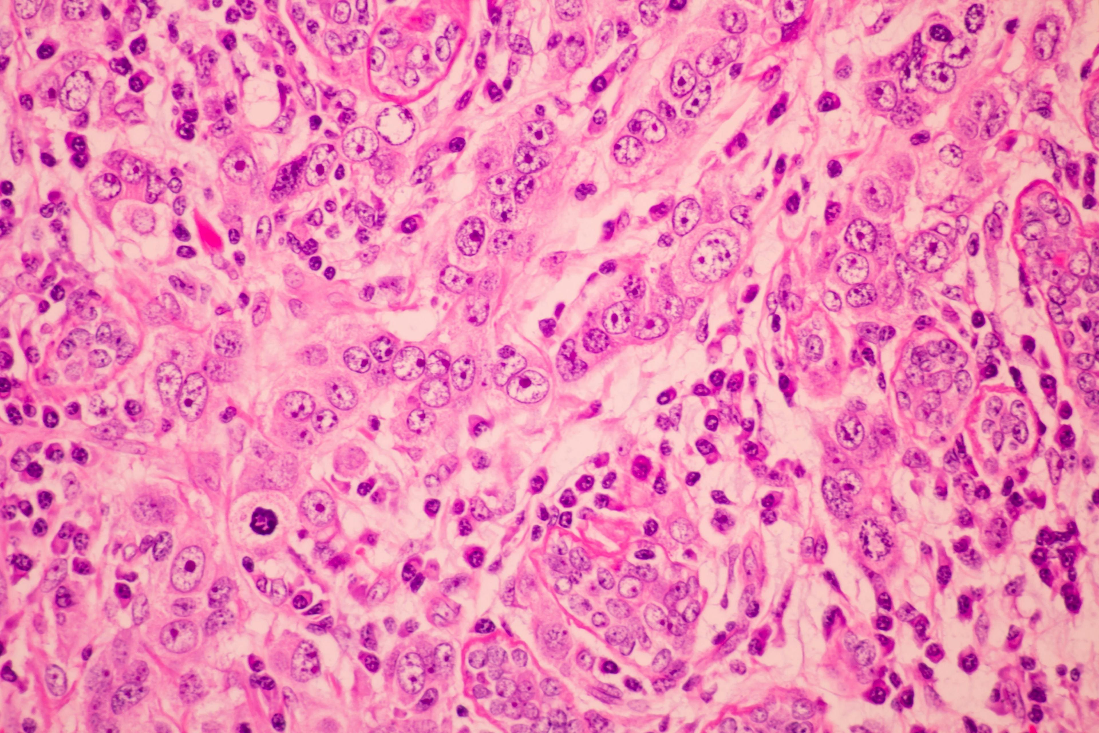 View in microscopic of pathology cross section tissue ductal cell carcinoma or adenocarcinoma diagnosis by pathologist in laboratory | Image Credit: arcyto - stock.adobe.com