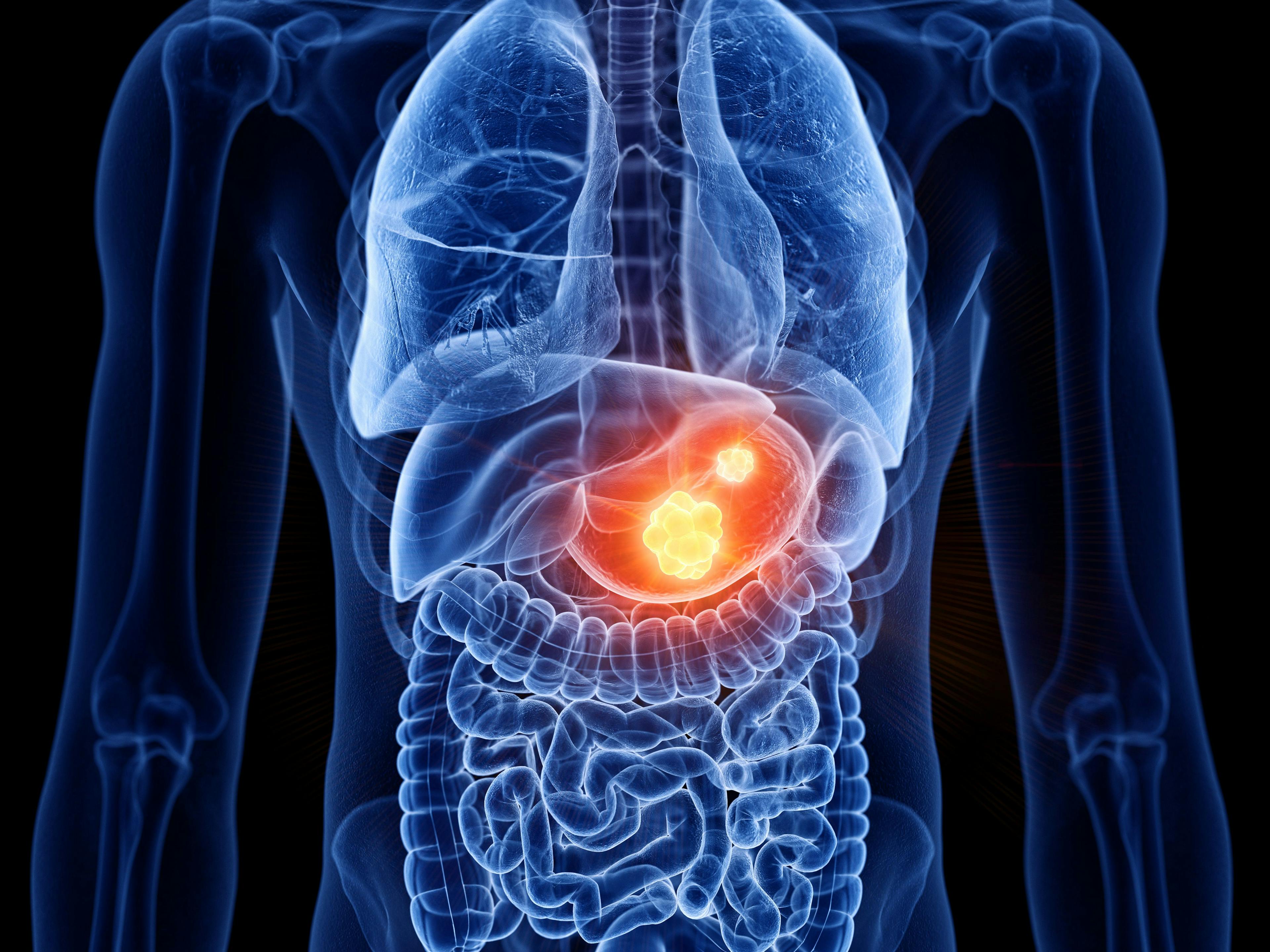 X-ray of tumor in stomach -- Image credit: Sebastian Kaulitzki | stock.adobe.com