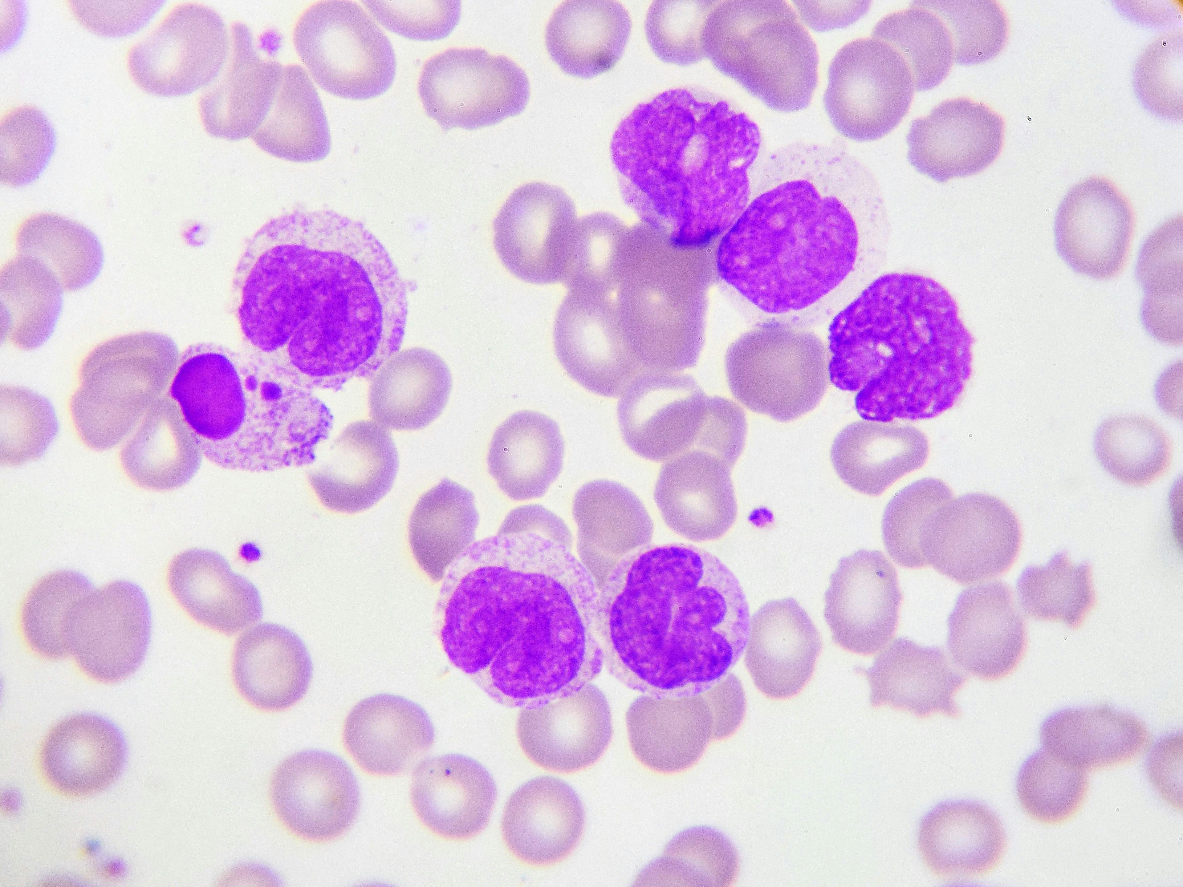 FDA Grants Fast Track Designation to Aptose’s HM43239 for Acute Myeloid Leukemia