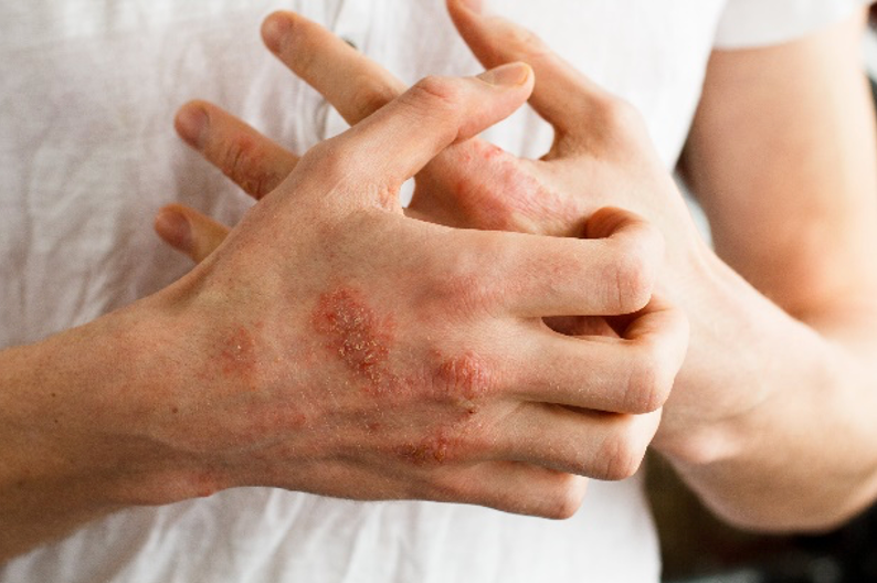 Pharmacy Clinical Pearl of the Day: Atopic Dermatitis