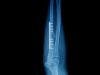 Allergy to Metal Orthopedic Implant Linked to Unusual Skin Cancer