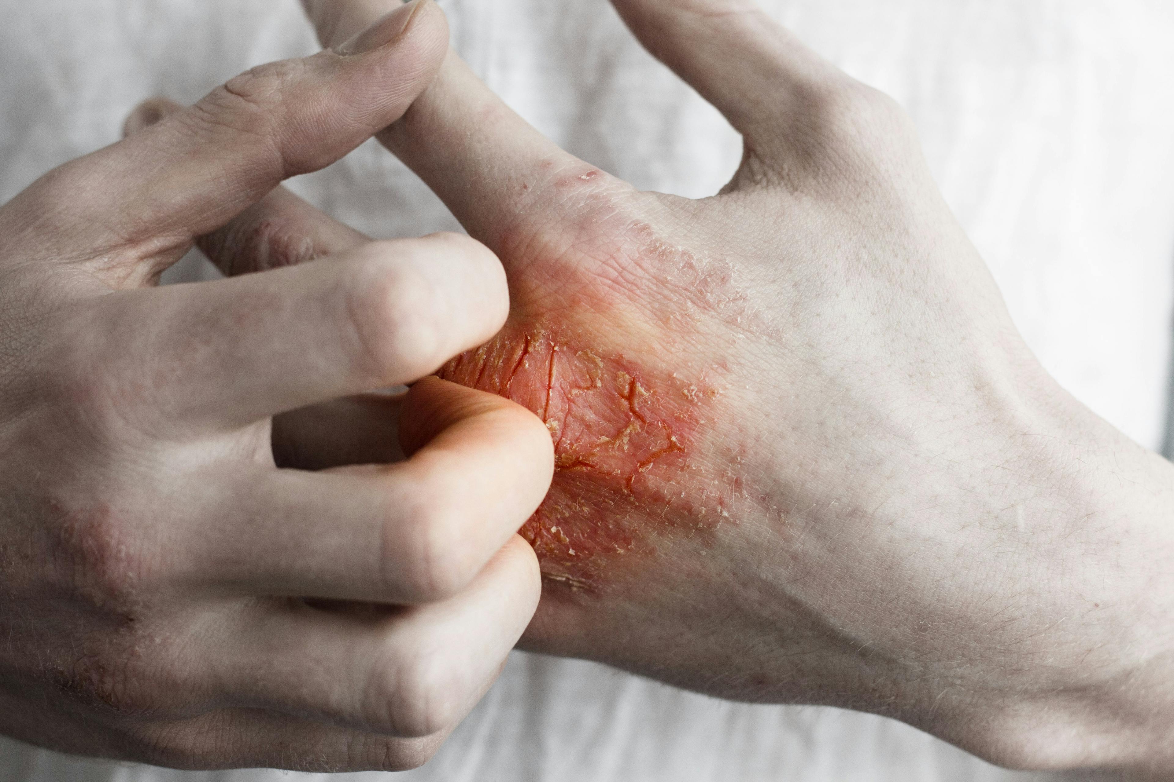 Study: Inhibiting S100A9 Gene in Skin Cells Reduces Severity of Psoriasis, Psoriatic Arthritis