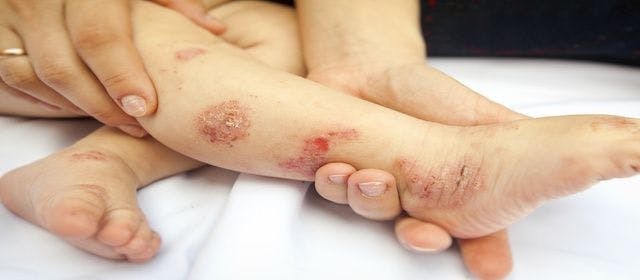 Dupilumab Shows Positive Results in Children with Severe Atopic Dermatitis