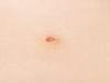 Surgical Resection Improves Survival in Melanoma Patients