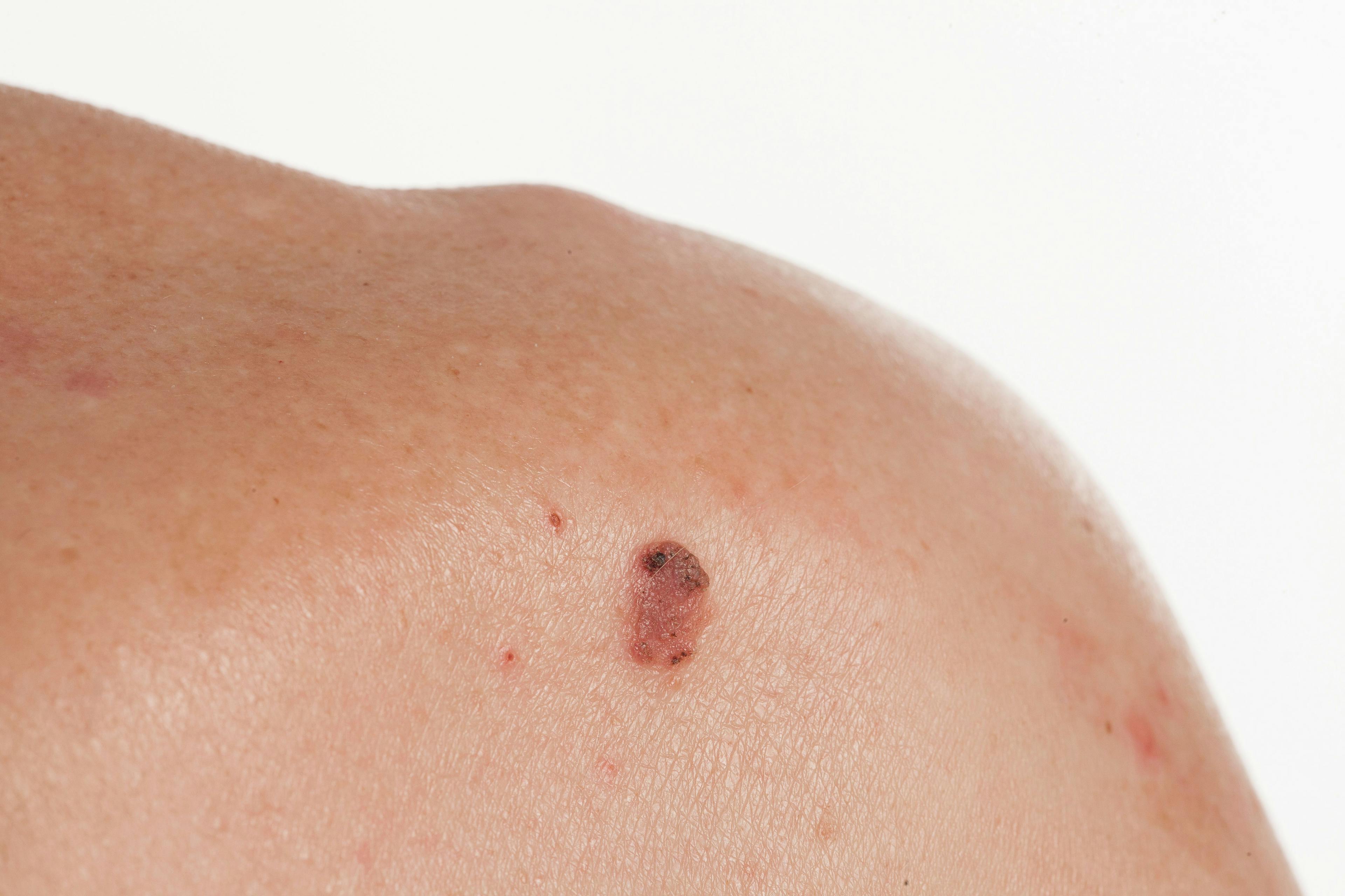 Keratinizing squamous cell carcinoma of the skin. Credit: 2707195204 - stock.adobe.com
