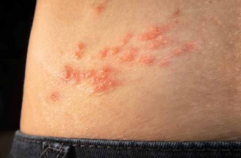 Pharmacy Clinical Pearl of the Day: Shingles Infection