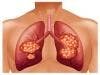 Study: Disparities Seen in Lung Cancer Care, Outcomes Between United States and England
