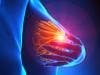 Researchers Target How Breast Cancer Forms