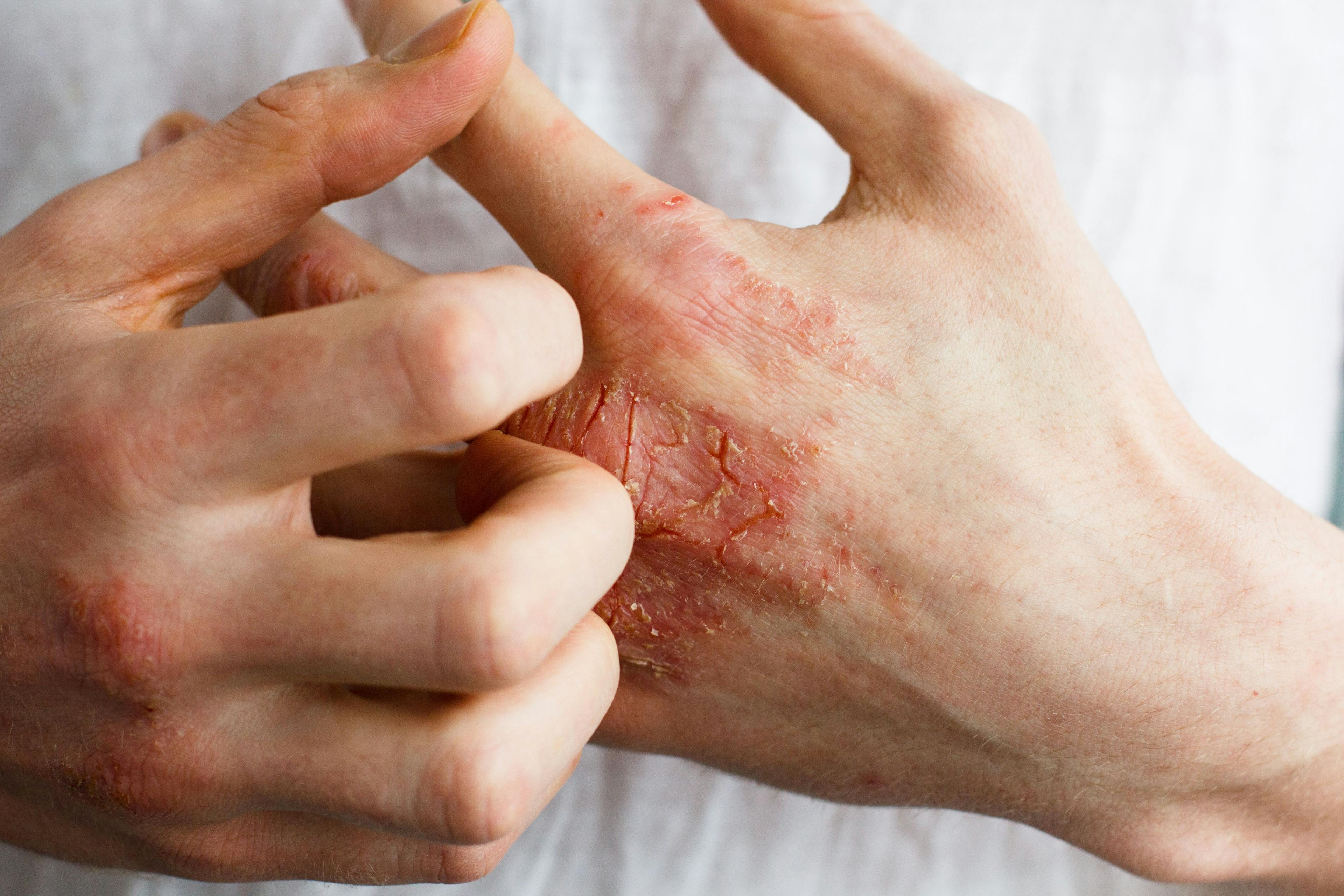 Atopic dermatitis on a patient's hand -- Image credit: Ольга Тернавская | stock.adobe.com