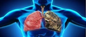 COPD Linked to Higher Lung Cancer Risk Among Smokers