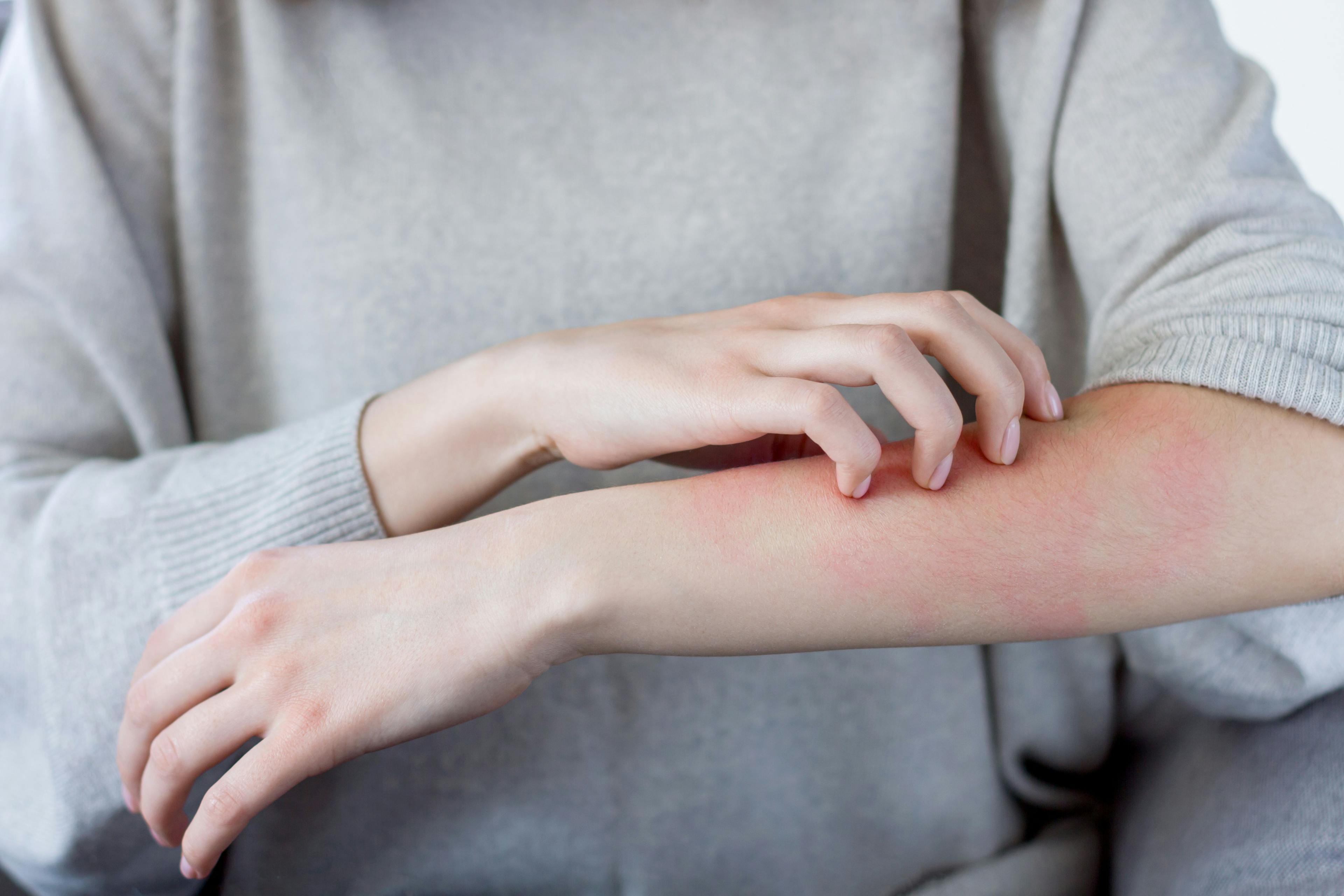 Closeup girl is scratching her hand with nails. Reddened, inflamed body parts causes discomfort and itching. Young woman is suffering from bouts of allergies. Dermatological skin diseases concept. | Image Credit: Monstar Studio - stock.adobe.com