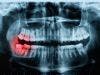 Bacterium That Causes Gum Disease May Trigger Rheumatoid Arthritis