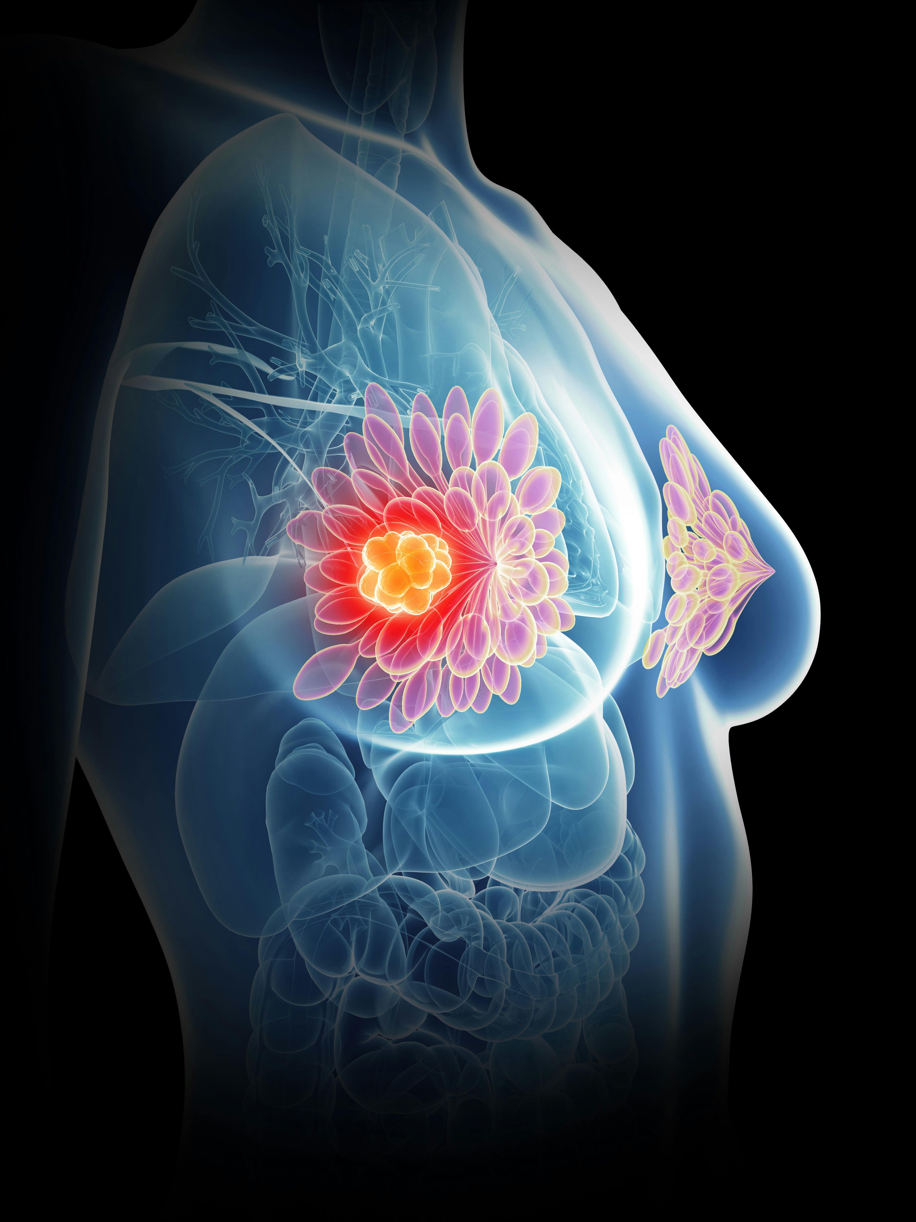 Survey Finds Most Women Unaware of the Signs of Aggressive, Deadly Type of Breast Cancer