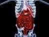 New Approach May Prevent Strictures in Crohn's Disease