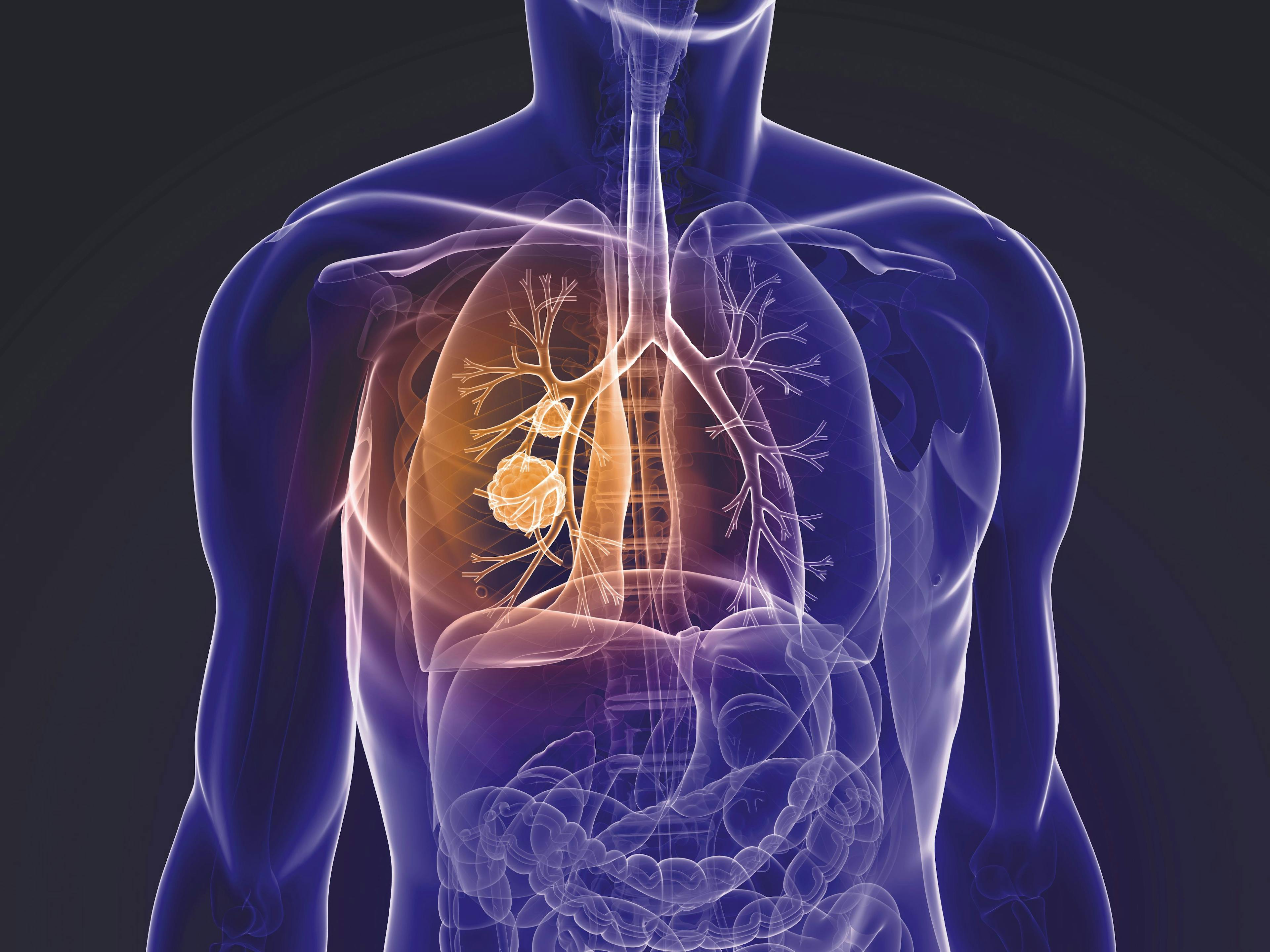 Neoadjuvant, Adjuvant Therapy for Resectable NSCLC Progresses With Immunotherapy, Targeted Therapy