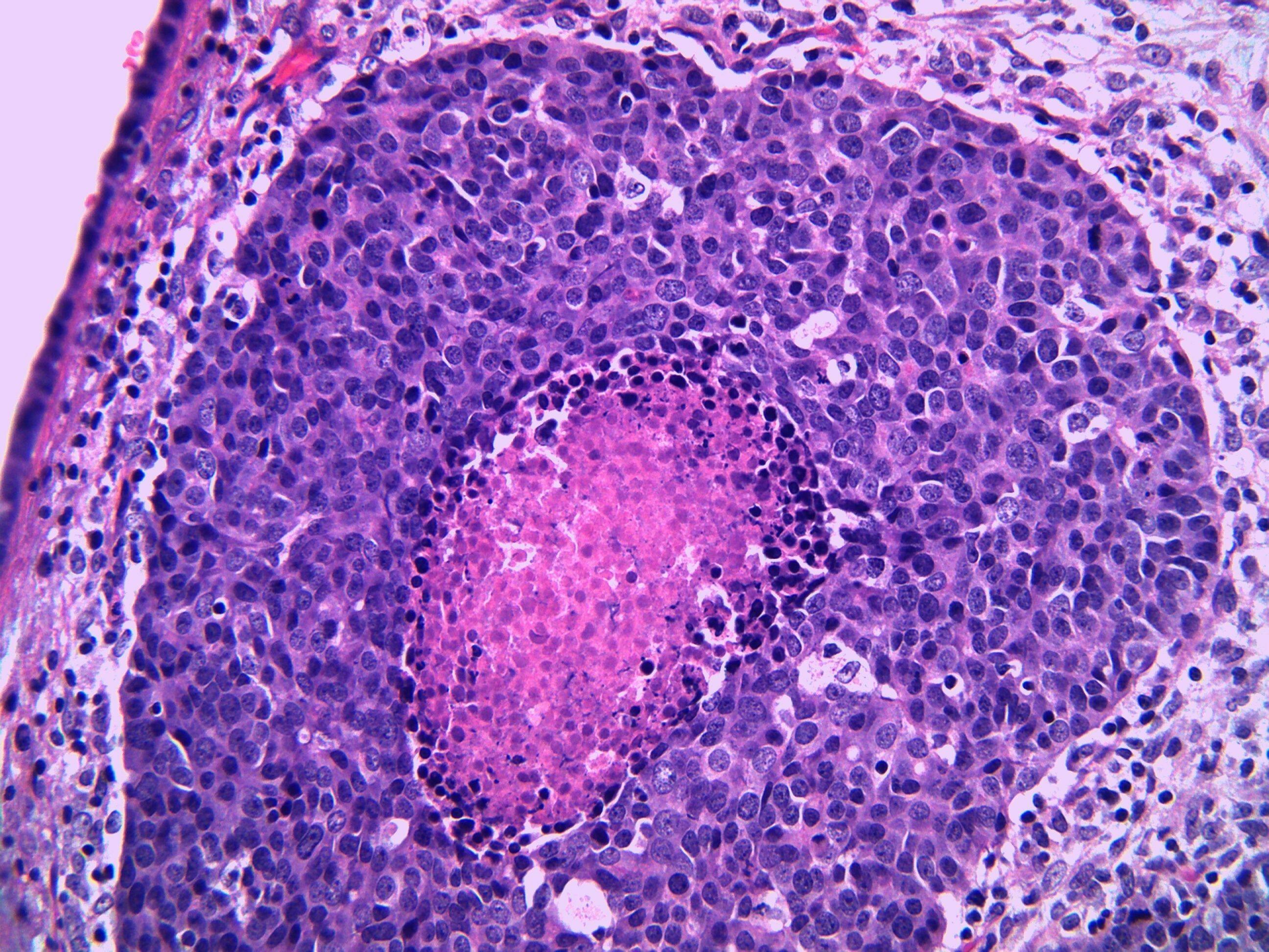 Detail of high grade urothelial carcinoma of the ureter in a man. The tumor has central necrosis which appears pink. Microscopic view.