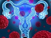 FDA Approves Avastin Plus Chemotherapy for Advanced Ovarian Cancer