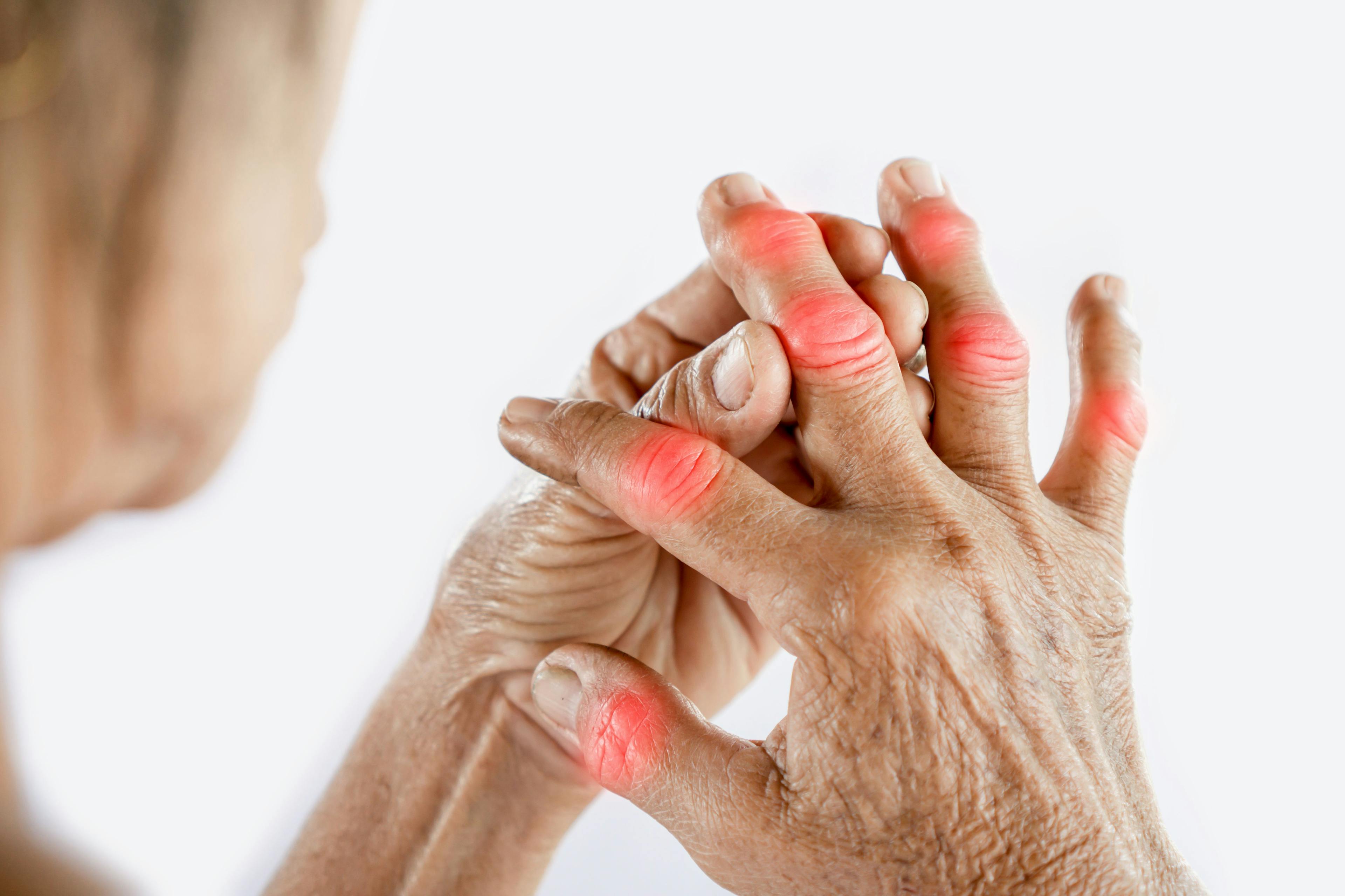 Hands of an older adult with arthritis | Image credit: doucefleur - stock.adobe.com