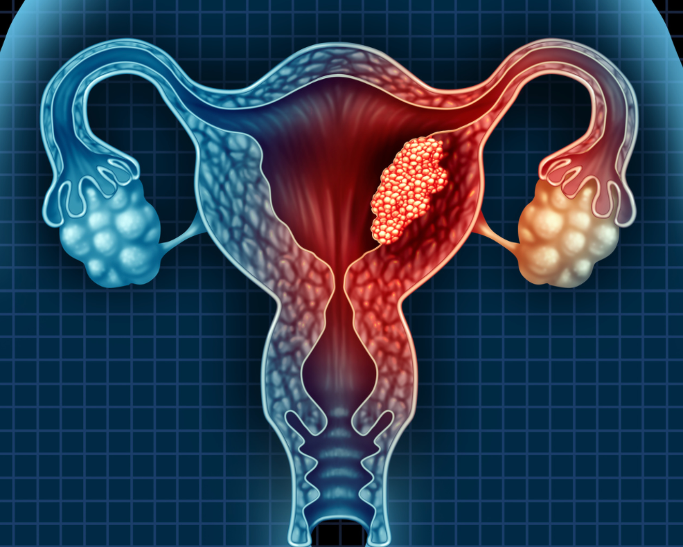 Pharmacy Quiz: Test Your Knowledge on Endometrial Cancer